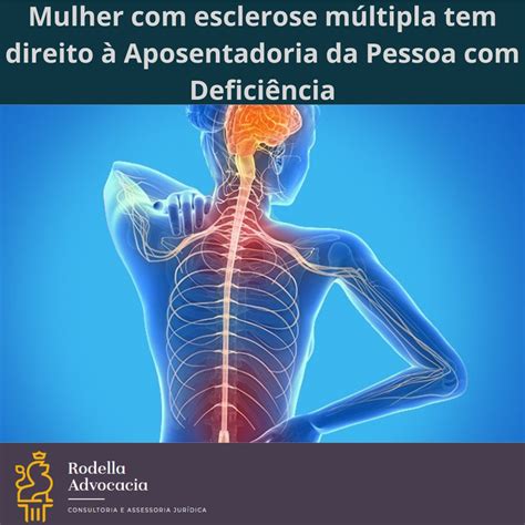 aposentadoria por esclerose multipla|Tenho um familiar que sofre com Esclerose Múltipla, qual.